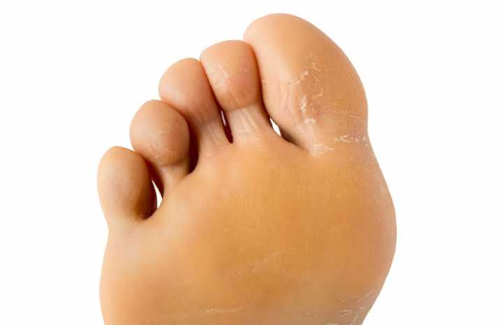 Nadpotliwość stóp